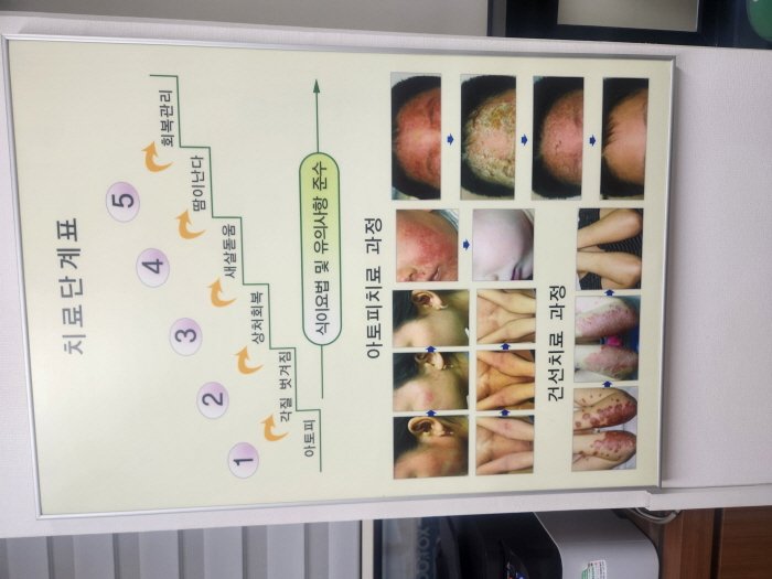 유아 아토피 순한 한약 잘하는 한의원